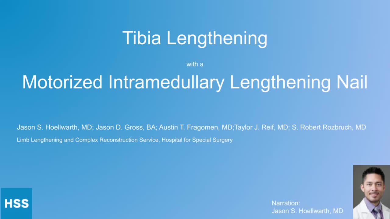 Intramedullary Limb Lengthening: Principles and Practice [ペーパーバック] Green， Stuart A.; Dahl， Mark T. The Future of Intramedullary Limb Lengthening | Springer Nature Link